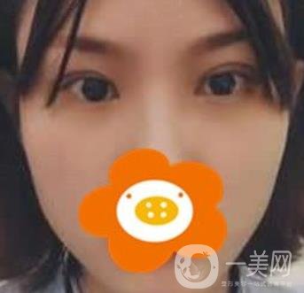 成都*做雙眼皮前后*果圖，附整形美容科價格收費(fèi)表一覽