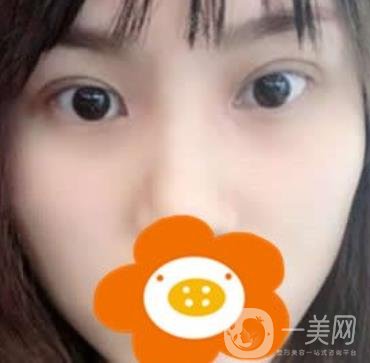 成都*做雙眼皮前后*果圖，附整形美容科價格收費(fèi)表一覽