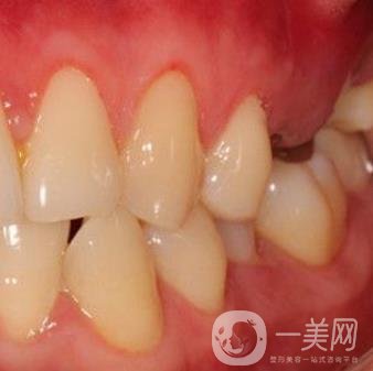 中大光華口腔醫(yī)院種植牙多少錢?價格表2020年項目明細(xì)一覽