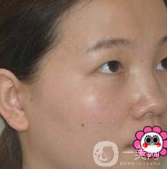 河南省人民醫(yī)院誰做雙眼皮好？附案例及2020整形價格表