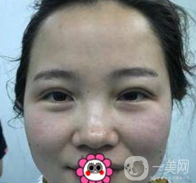 河南省人民醫(yī)院誰做雙眼皮好？附案例及2020整形價格表