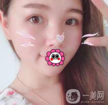 河南省人民醫(yī)院誰做雙眼皮好？附案例及2020整形價格表