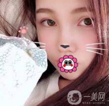 河南省人民醫(yī)院誰做雙眼皮好？附案例及2020整形價格表