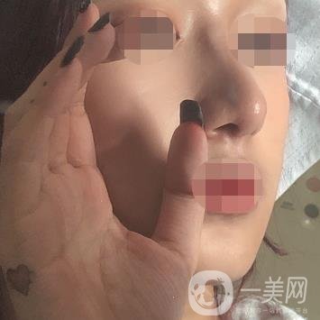 遼寧省人民醫(yī)院美容科怎么樣？附袁繼龍隆鼻案例