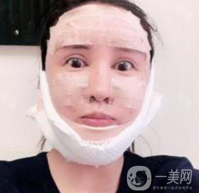 北大醫(yī)院美容價(jià)格表，附自體脂肪填充面部前后照