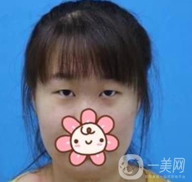 2020浙江省人民醫(yī)院整形價(jià)格表，附雙眼皮案例