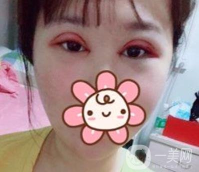 2020浙江省人民醫(yī)院整形價(jià)格表，附雙眼皮案例