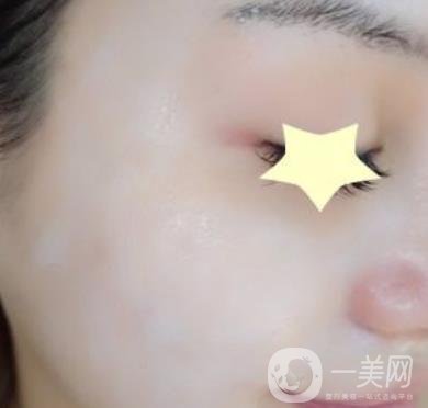 珠海中西醫(yī)結(jié)合醫(yī)院整形價(jià)格表及激光祛斑案例一覽