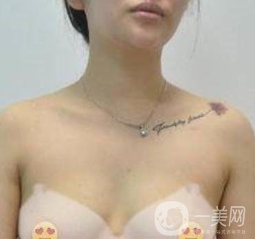 福州市第一醫(yī)院隆胸