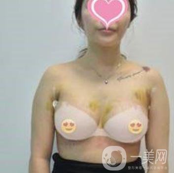 福州市第一醫(yī)院隆胸