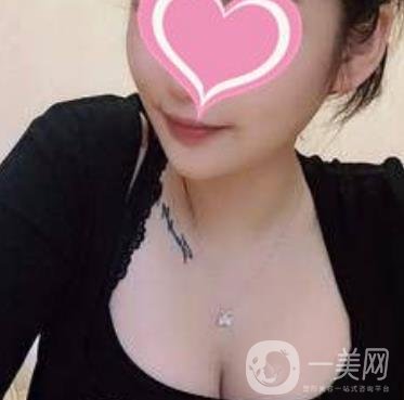 福州市第一醫(yī)院隆胸