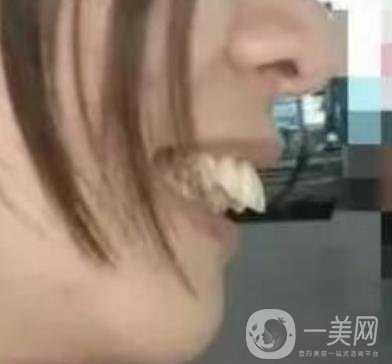 福建醫(yī)大口腔醫(yī)院整牙