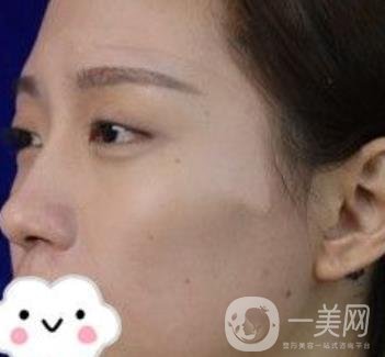 交大一附院何林做雙眼皮好嗎？?jī)r(jià)格表及術(shù)后*果分享