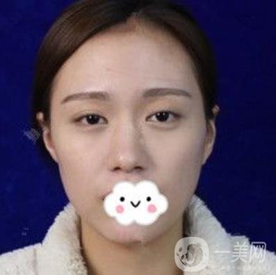 交大一附院何林做雙眼皮好嗎？?jī)r(jià)格表及術(shù)后*果分享