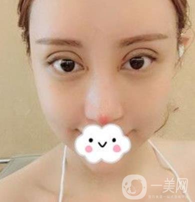 交大一附院何林做雙眼皮好嗎？?jī)r(jià)格表及術(shù)后*果分享