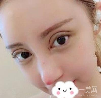 交大一附院何林做雙眼皮好嗎？?jī)r(jià)格表及術(shù)后*果分享