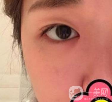 山大二院整形科2020價格表公布,附雙眼皮案例術(shù)后*果圖