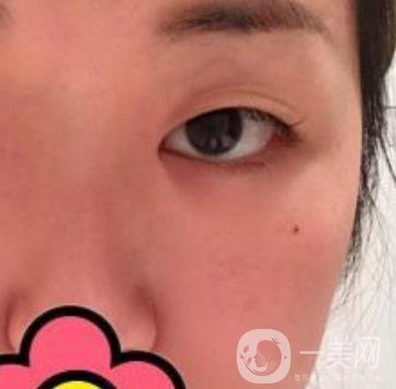 山大二院整形科2020價格表公布,附雙眼皮案例術(shù)后*果圖