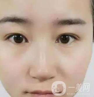 長海醫(yī)院邢新做雙眼皮修復(fù)好嗎？價(jià)格表及案例詳情一覽