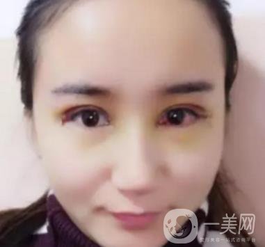 長海醫(yī)院邢新做雙眼皮修復(fù)好嗎？價(jià)格表及案例詳情一覽