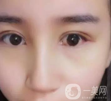 長海醫(yī)院邢新做雙眼皮修復(fù)好嗎？價(jià)格表及案例詳情一覽