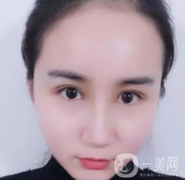 長海醫(yī)院邢新做雙眼皮修復(fù)好嗎？價(jià)格表及案例詳情一覽