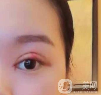 河北省人民醫(yī)院做雙眼皮咋樣?價(jià)格表一覽