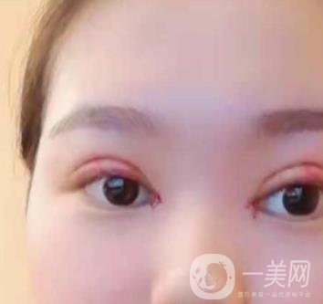 河北省人民醫(yī)院做雙眼皮咋樣?價(jià)格表一覽