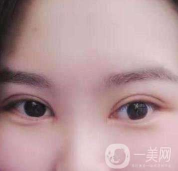 河北省人民醫(yī)院做雙眼皮咋樣?價(jià)格表一覽