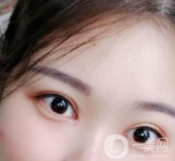 河北省人民醫(yī)院做雙眼皮咋樣?價(jià)格表一覽