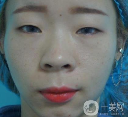 北京彤美醫(yī)療整形醫(yī)院價格表，附桂行軍雙眼皮術(shù)后*果一覽