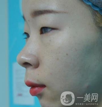 北京彤美醫(yī)療整形醫(yī)院價格表，附桂行軍雙眼皮術(shù)后*果一覽