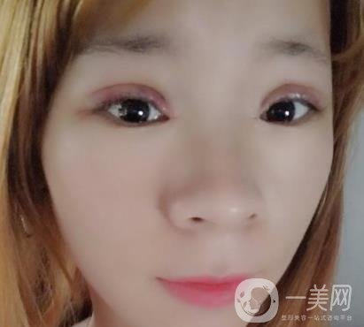 北京彤美醫(yī)療整形醫(yī)院價格表，附桂行軍雙眼皮術(shù)后*果一覽