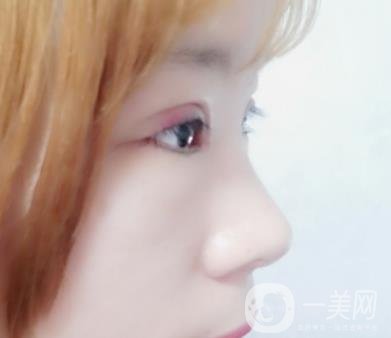 北京彤美醫(yī)療整形醫(yī)院價格表，附桂行軍雙眼皮術(shù)后*果一覽