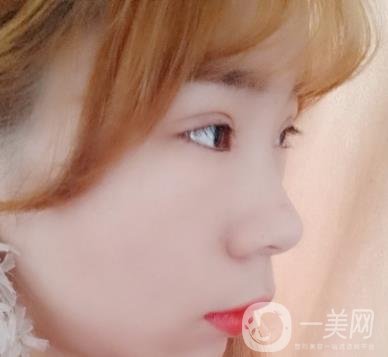 北京彤美醫(yī)療整形醫(yī)院價格表，附桂行軍雙眼皮術(shù)后*果一覽