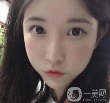 成都華美醫(yī)院做眉毛怎么樣?真實(shí)*果圖和價(jià)格一覽表展示