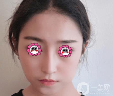 北京圣嘉榮整形價(jià)格表，內(nèi)附黃大勇整形醫(yī)生顴骨內(nèi)推案例*果圖展示