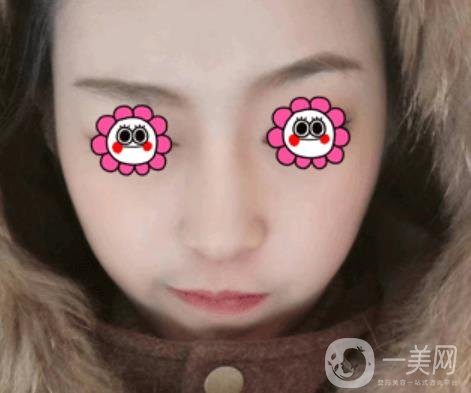 北京圣嘉榮整形價(jià)格表，內(nèi)附黃大勇整形醫(yī)生顴骨內(nèi)推案例*果圖展示