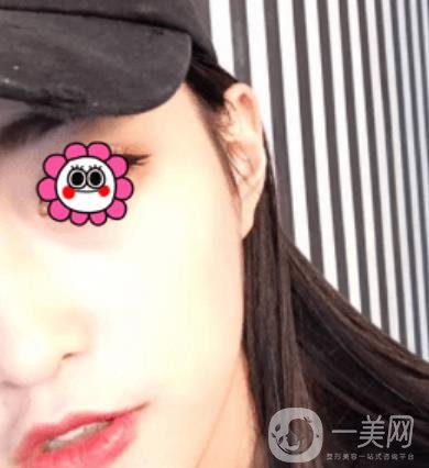 北京圣嘉榮整形價(jià)格表，內(nèi)附黃大勇整形醫(yī)生顴骨內(nèi)推案例*果圖展示