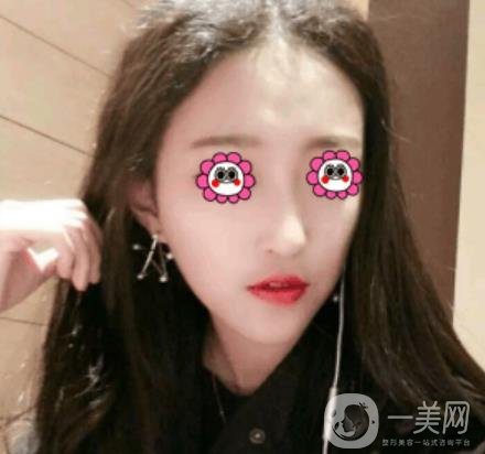 北京圣嘉榮整形價(jià)格表，內(nèi)附黃大勇整形醫(yī)生顴骨內(nèi)推案例*果圖展示