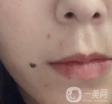 重慶附一院整形科價格表2020年公布，附祛痣整形日記