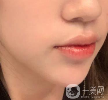 重慶附一院整形科價格表2020年公布，附祛痣整形日記