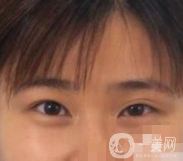 北京韓勛雙眼皮修復(fù)怎么樣？附整形價(jià)格表一覽