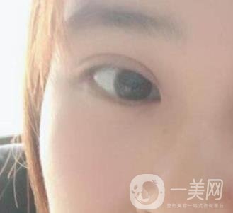 北京韓勛雙眼皮修復(fù)怎么樣？附整形價(jià)格表一覽