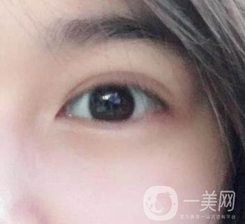 北京韓勛雙眼皮修復(fù)怎么樣？附整形價(jià)格表一覽