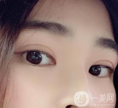 北京韓勛雙眼皮修復(fù)怎么樣？附整形價(jià)格表一覽