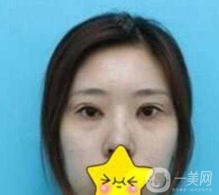 濟(jì)寧附屬醫(yī)院做雙眼皮多少錢？附真實(shí)案例及整形價(jià)格表