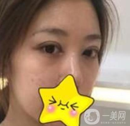 濟(jì)寧附屬醫(yī)院做雙眼皮多少錢？附真實(shí)案例及整形價(jià)格表