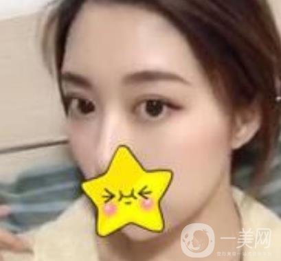 濟(jì)寧附屬醫(yī)院做雙眼皮多少錢？附真實(shí)案例及整形價(jià)格表