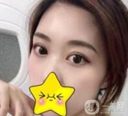 濟(jì)寧附屬醫(yī)院做雙眼皮多少錢？附真實(shí)案例及整形價(jià)格表